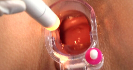 Mix - Iris Exam_2 Siterip Gyno